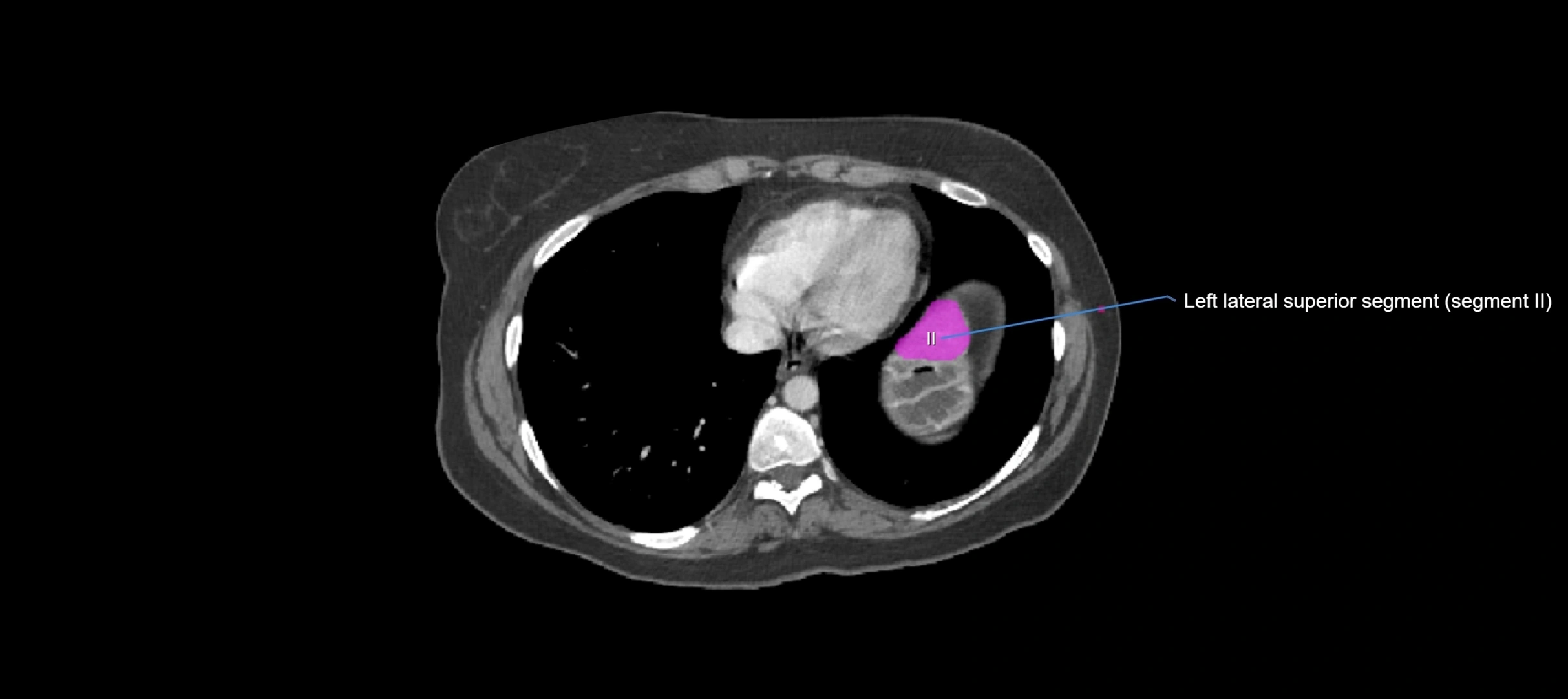 CT liver segments axial cross sectional anatomy labelled image-00078.webp